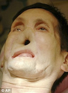 美國第二位“換臉”人術后現(xiàn)身 對新生活充滿希冀