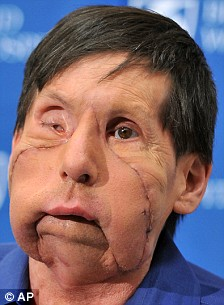 美國第二位“換臉”人術后現(xiàn)身 對新生活充滿希冀