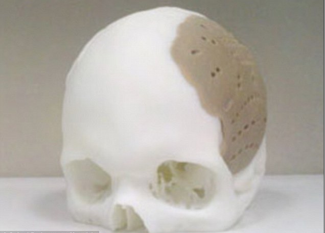 頭骨也能打??！美公司用3D打印技術(shù)造福移植患者