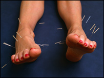 Health: Acupuncture in the UK 健康：針灸在英國(guó)