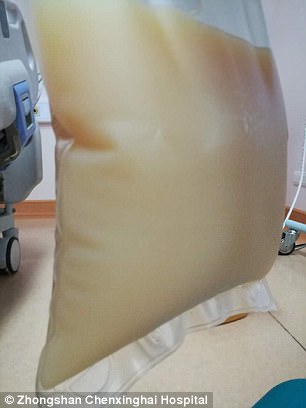 中山男子腹痛緊急送醫(yī)搶救，檢出“牛奶血”！