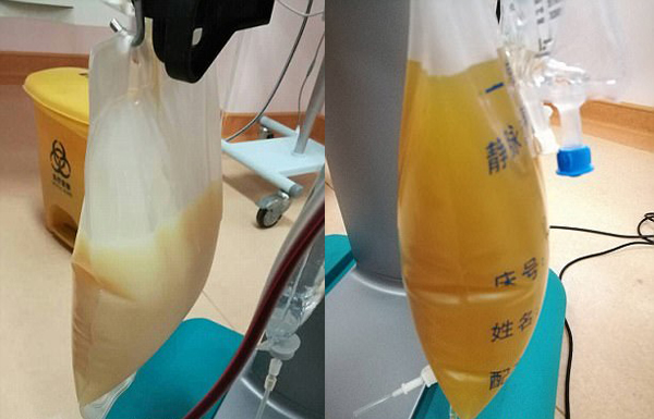 中山男子腹痛緊急送醫(yī)搶救，檢出“牛奶血”！